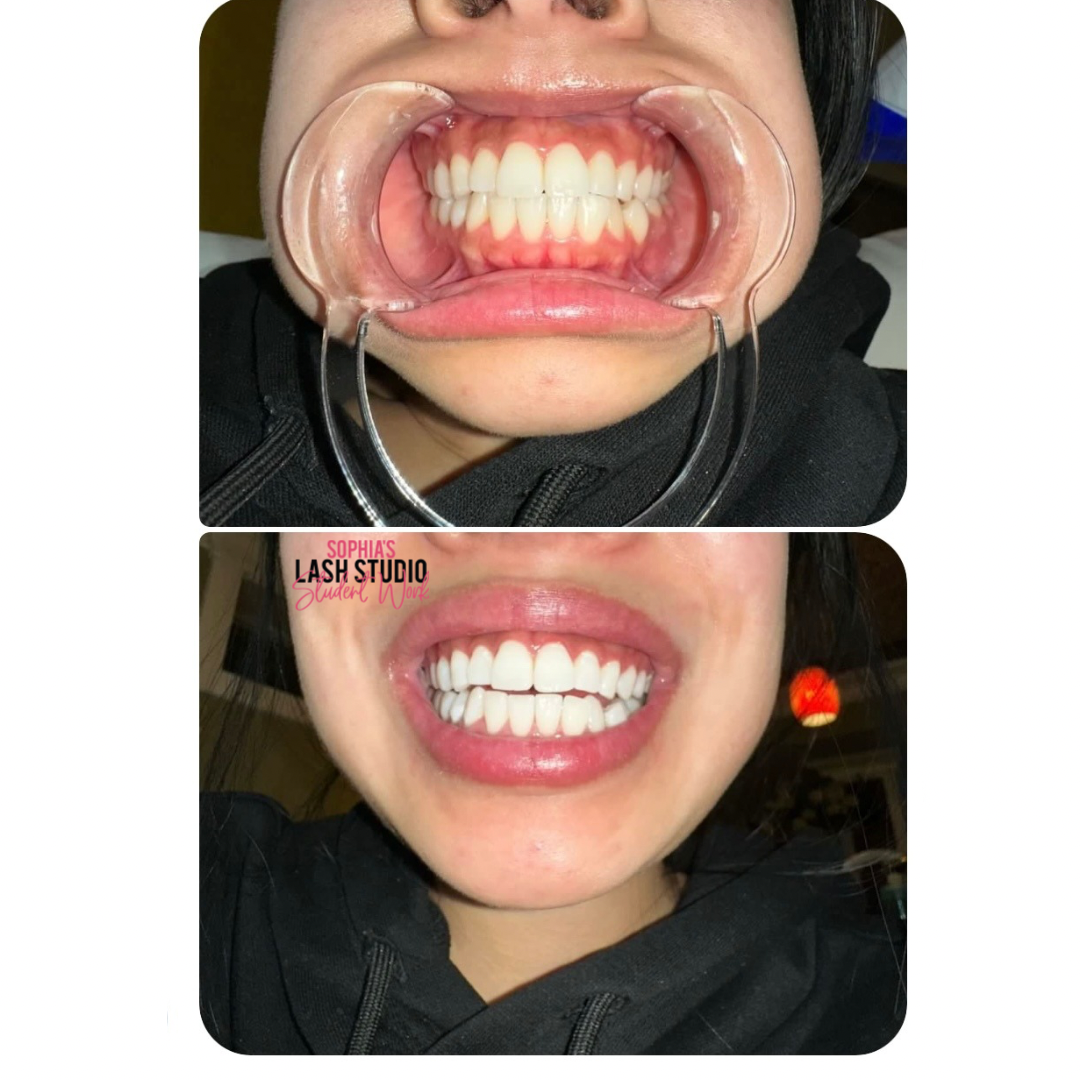 Online Teeth Whitening Course