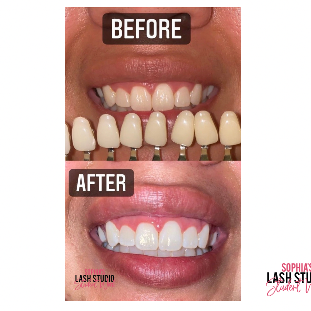 Online Teeth Whitening Course