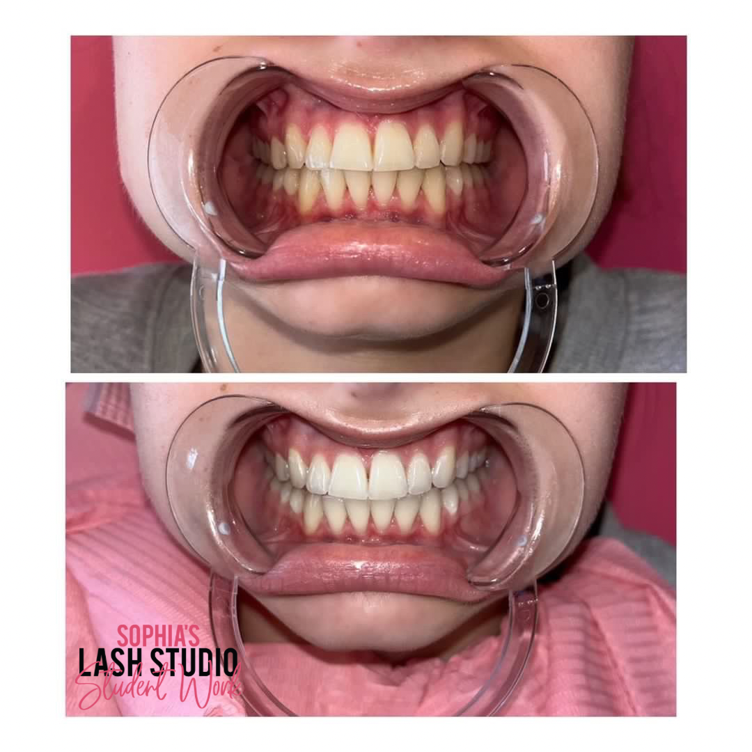 Online Teeth Whitening Course