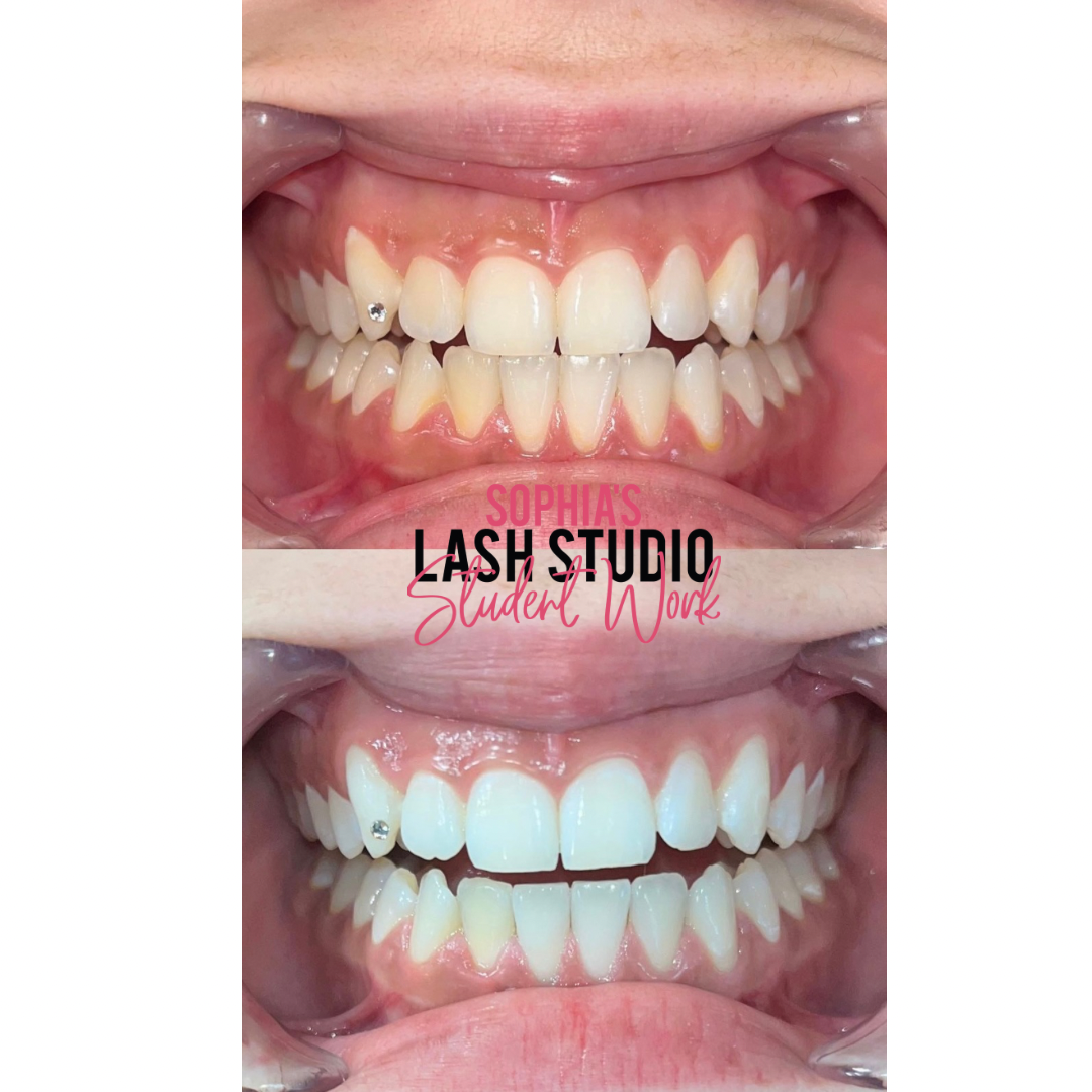 Online Teeth Whitening Course